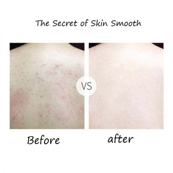 Kp Bump Eraser Body Scrub Target Body Exfoliator For Sensitive Skin